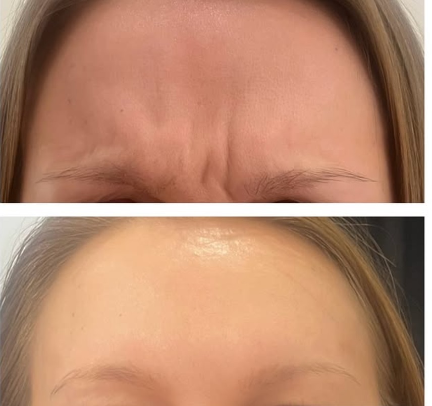 Goda resultat inom Botox för dig i Vasastan